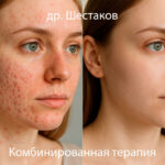 Угревая сыпь