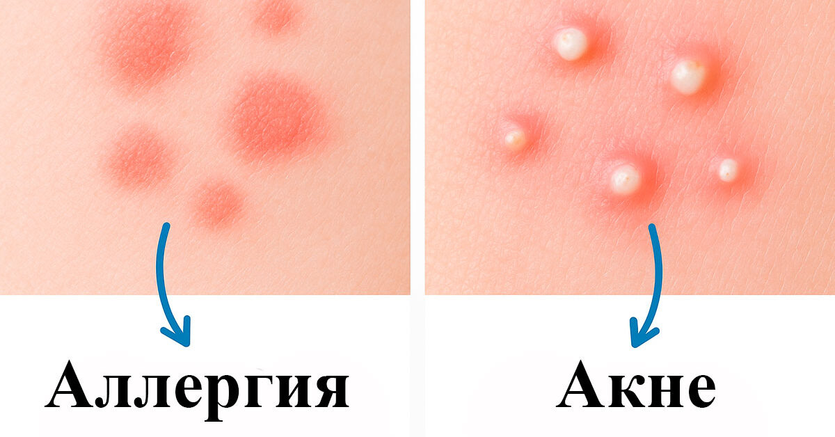 Акне или аллергия