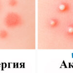 Акне или аллергия