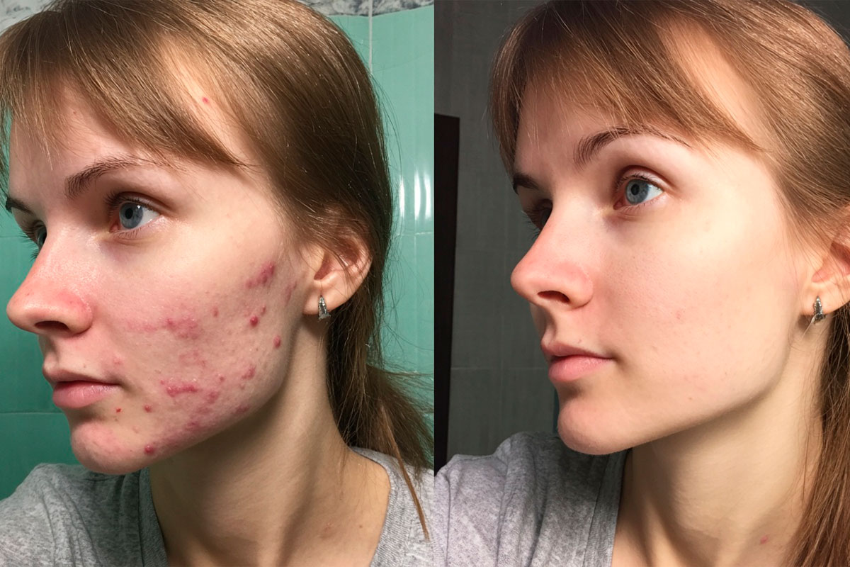 Эффективное лечение акне
