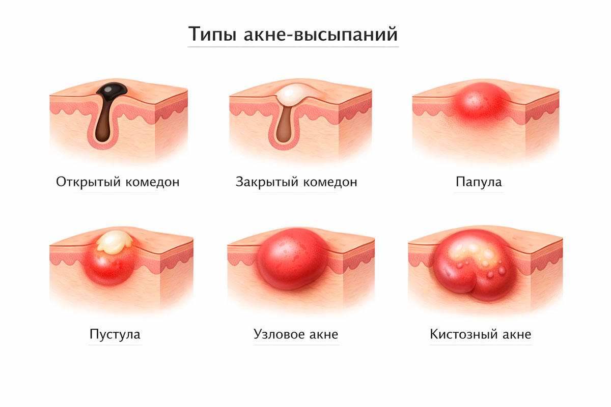 Виды акне: комедоны, папулы, пустулы и узловые элементы